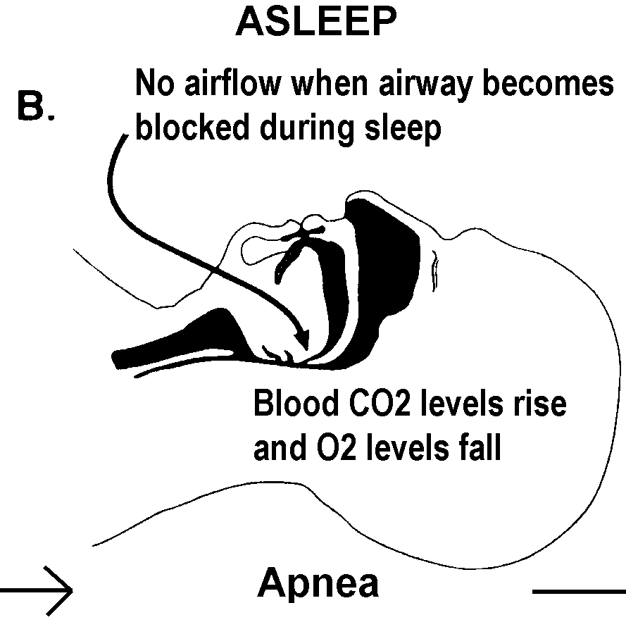 A Patients Guide To Understanding Sleep Apnea Sleep Consultants Inc 6914